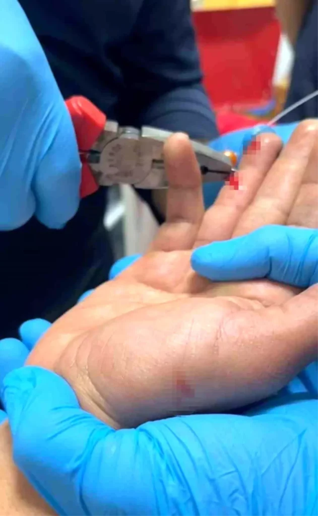 Balık macerası hastanede bitti: Parmağına saplanan olta iğnesini itfaiye çıkarttı